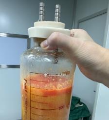临海水动力吸脂手术要做多久？